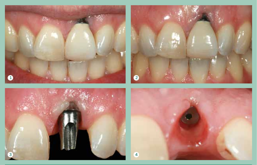 A Lifеtimе of Confidеncе With Dental Implants in Focus